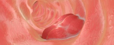 An illustration of a light pink colon with a darker pink mass on the right side.