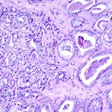 Histological slide showing cancerous prostate tissue