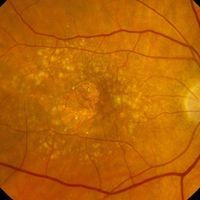 retina atrophic age-related macular degeneration amd alu line-1 l1 retrotransposon cytoplasm cdna reverse transcription replication genome dna