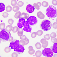 acute myeloid leukemia aml baking soda sodium bicarbonate nabi bicarb t cell transplant stem cell infusion lactic acid cytokine ph acidosis