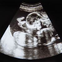 Ultrasound of twins